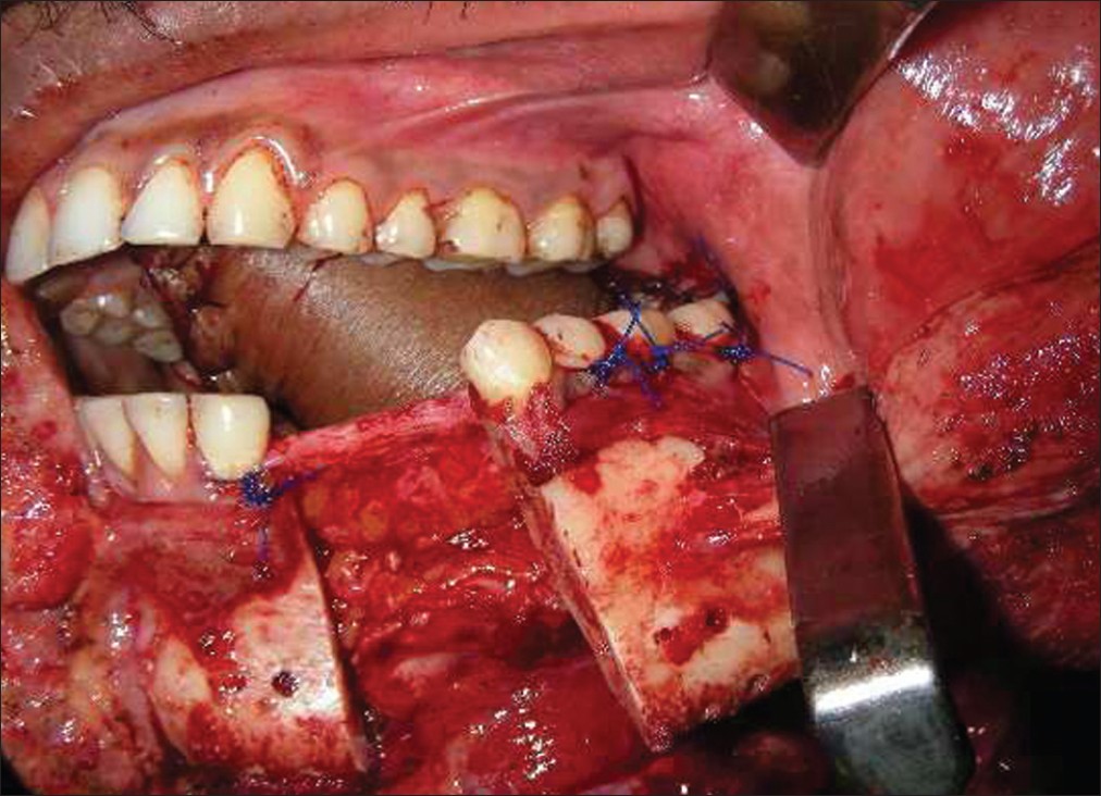 Figure 3: Intraoperative photograph showing the stitches taken on multiple adjacent teeth