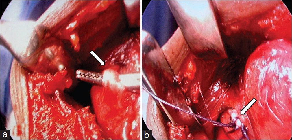 Figure 2: The superior pedicle seen under magnification (a) and secured with sutures (b)