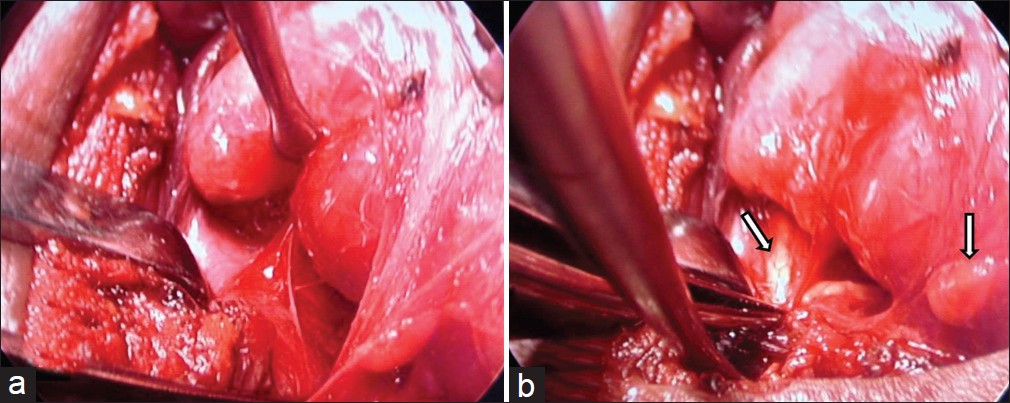 Figure 3: (a) Endoscopic view of dissection in the lateral compartment. (b) The endoscope provides a magnified view of the parathyroids (white arrows)