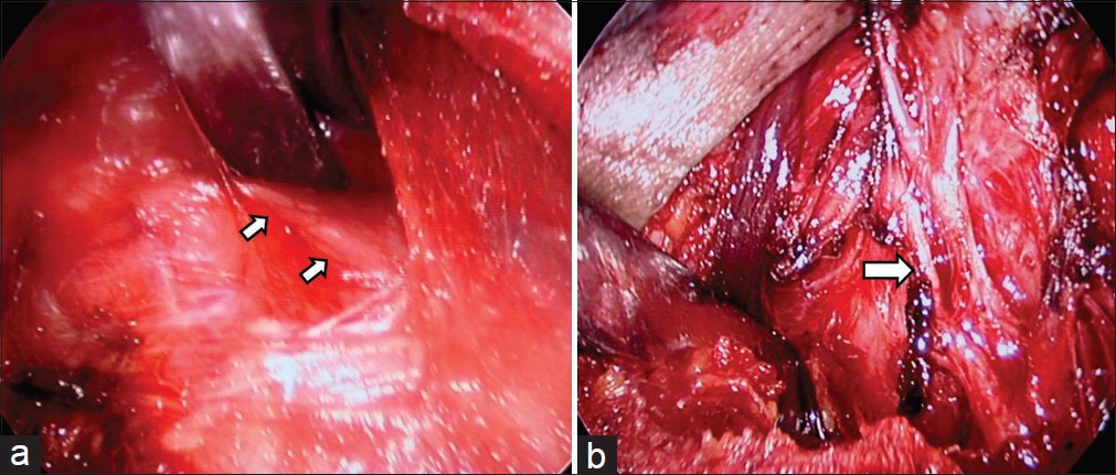 Figure 4: The recurrent laryngeal nerve (white arrows) is seen during dissection (a) and after removal of the gland (b)