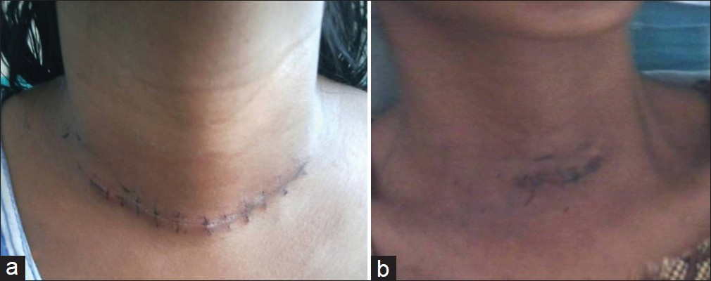 Figure 5: The size of the incision for GVAT (b) is much smaller than that of our standard thyroidectomy (a)