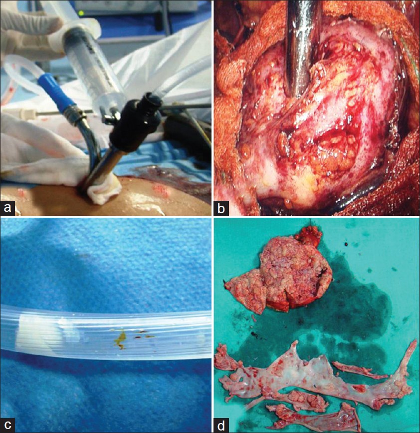 Figure 3: (a) Palanivelu hydatid system outer cannula consisting of two side channels for suction and irrigation. (b) Intraoperative placement of PHS over the surface of hydatid cyst. (c) Hydatid scolices seen through suction tube. (d) Renal hydatid cyst cut opened after surgical removal with aspiratedscolices and laminated membranes