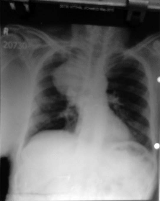 Figure 2: X‑Ray of the chest showing meningoceles as a mass lesion