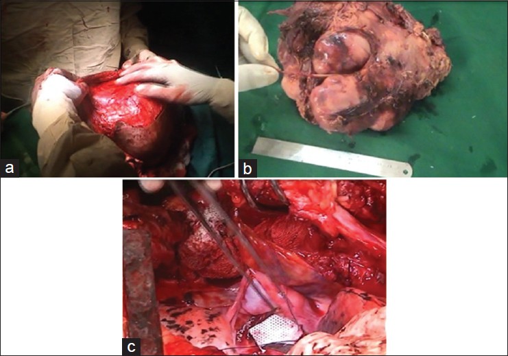 Figure 4: (a) Intraoperative photo while raising skin flaps. (b) Tumor
with the lateral thoracic nerve excised in TOTO. (c) Repair of
meningocele defects being done with a G‑patch (artificial dural patch)