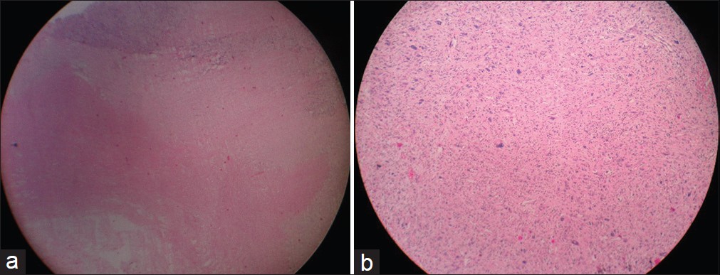 Figure 5: (a) Histopathology scanner view (×4) showing tumor with
areas of necrosis. (b) Histopathology photographic view (×10) showing
tumor cells arranged in fascicles with nuclear pleomorphism