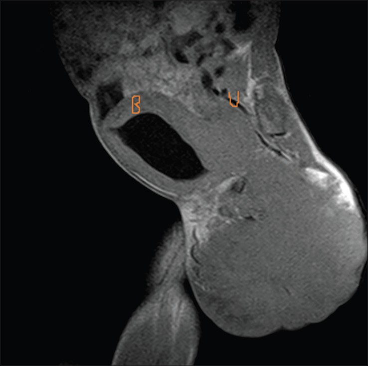 Figure 2: Magnetic resonance imaging. The sagittal view shows a
tumor involving the bladder (B) and the uterus (U)