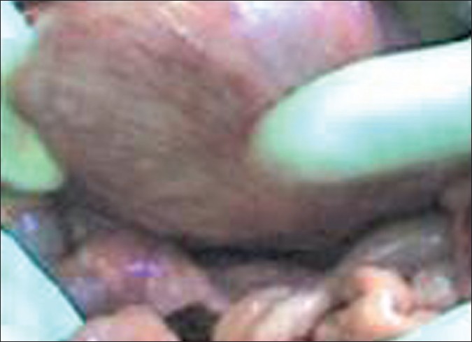 Figure 3: Intraoperative findings showing the tumor involving the bladder