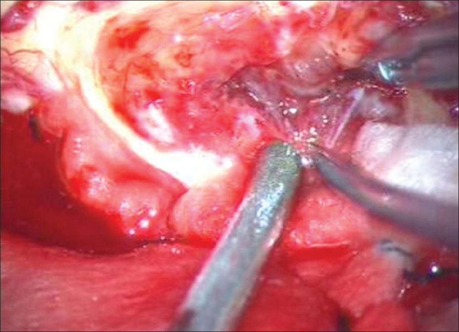 Figure 2: Intraoperative view of a grayish solid component of the tumor, with a good cleavage plane