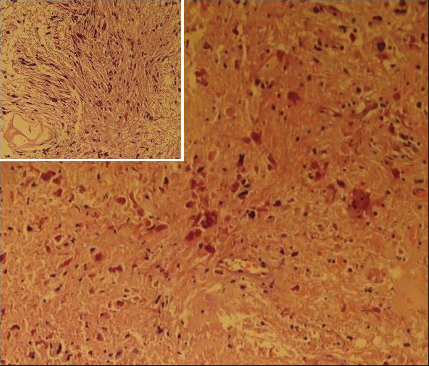Figure 3: Histopathology showing rosenthal fibers and compact cells with loosely arranged piloid cells (inset)