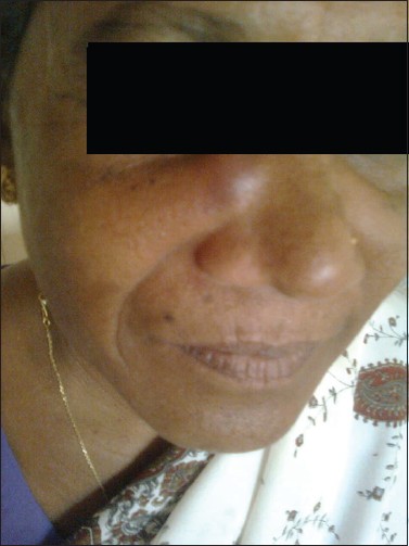 Figure 1: A 45-year-old lady with swelling on right side of nose