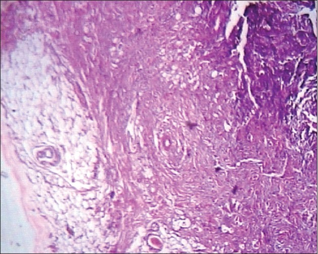 Figure 3: HPE of spindle cell lipoma