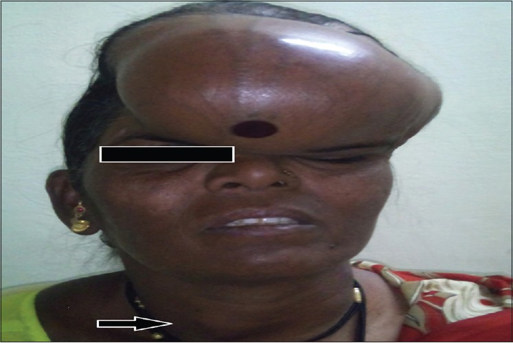 Figure 1: A 13 × 18 cm metastasis follicular thyroid carcinoma in frontal region of skull swelling with distended and engorged veins suggesting increased vascularity and also showing incidentally noted 3 × 2 cm thyroid swelling the primary lesion involving right lobe of thyroid