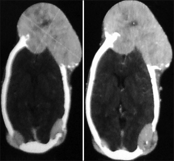 Figure 3: CT scan showing multiple osteolytic lesions with contrast enhancement and central necrosis
