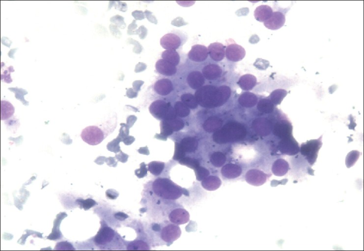 Figure 4: FNAC from skull swelling showing presence of thyroid cells confirming the metastatic nature of swellings from follicular carcinoma thyroid