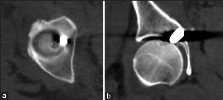 Figure 3: (a) Axial computed tomography scan showing the bullet embedded in the medial acetabular wall intra-articularly, (b) Coronal computed tomography scan showing the bullet embedded in the medial acetabular wall intra-articularly