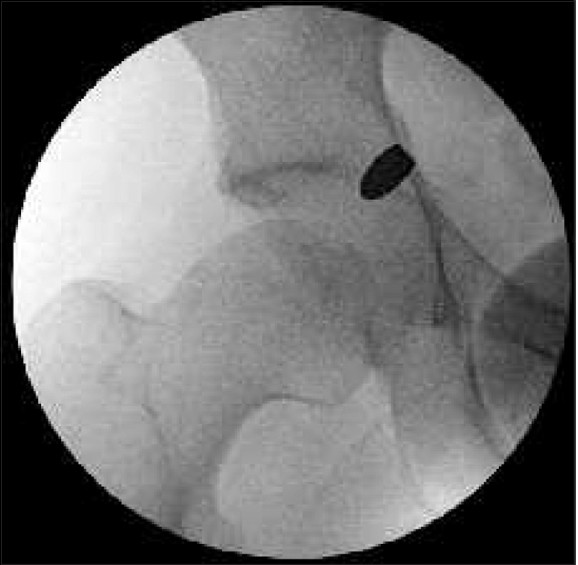 Figure 4: Fluoroscopic image showing the site of the bullet