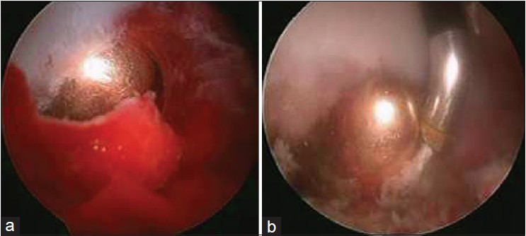 Figure 5: (a) Arthroscopic view showing the bullet embedded in the medial acetabular wall, (b) Arthroscopic view showing the bullet embedded in the medial acetabular wall