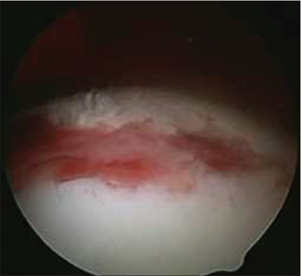 Figure 7: The surface of the femoral head was damaged by the projectile
