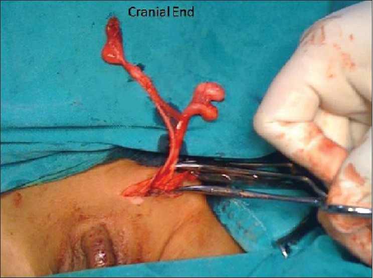 Figure 1: Operative photograph showing two testis on left side with their respective epididymis draining into one vas