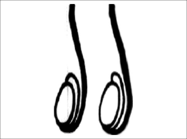 Figure 5: Type-IV: Complete duplication of testes, epididymis and vas. (Vertical division of genital ridge and mesonephros)