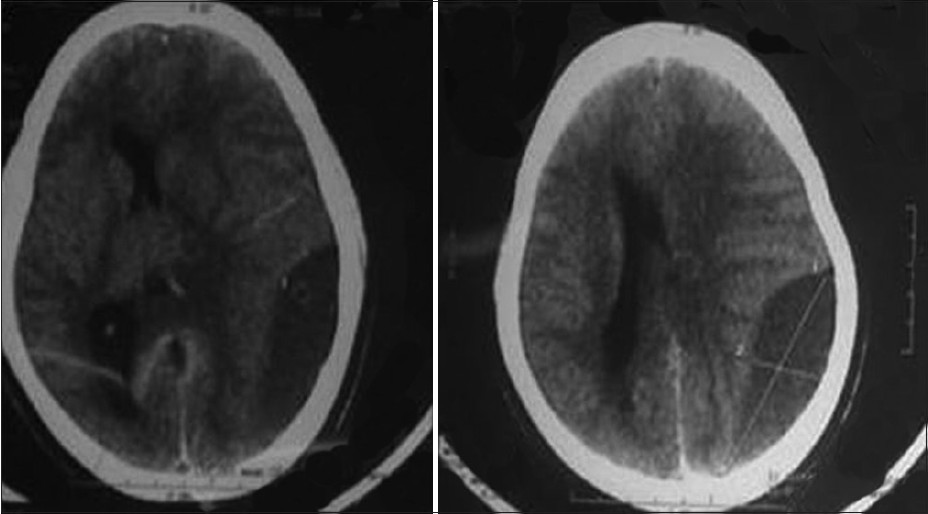 Figure 1: Chronic subdural haematoma with midline shift and gross mass effect