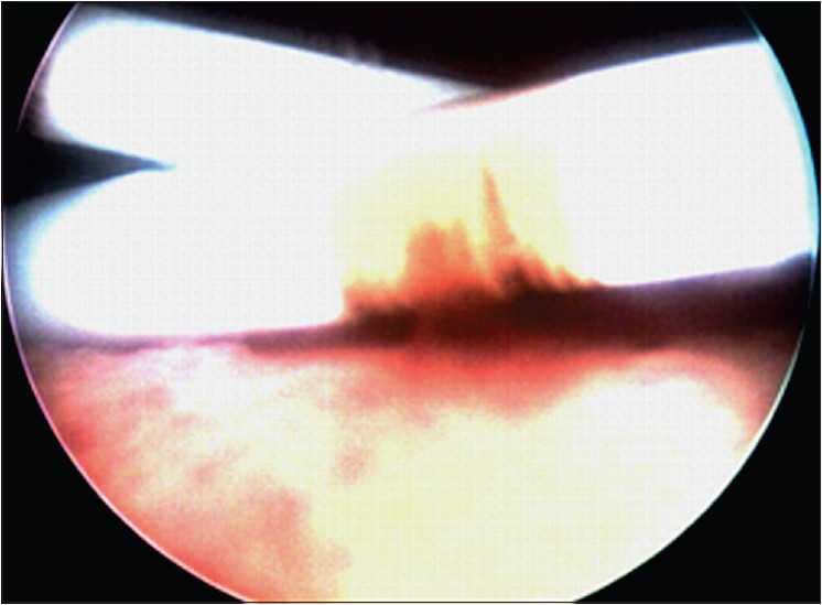 Figure 1: Cystoscopic appearance of two DJ stents crossing like a 