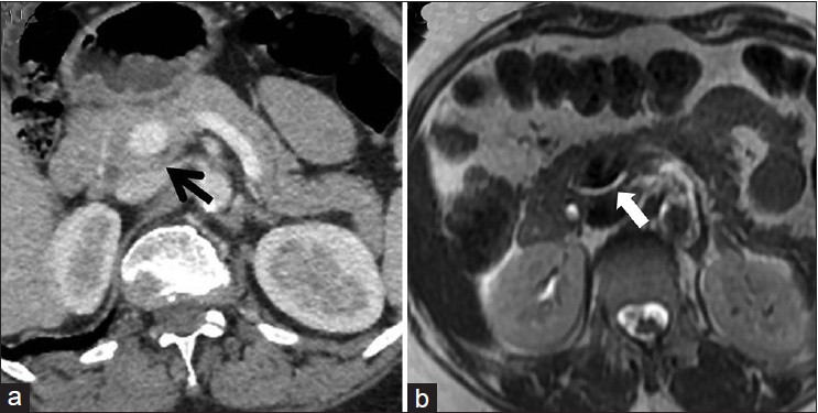 Figure 1: (a) Axial contrast-enhanced abdominal computed tomography scan displays a rind of pancreatic tissue encircling the portal vein consistent with portal annular pancreas. (b) Axial T2-weighted magnetic resonance imaging in addition displays the retroportal main pancreatic duct traversing posterior to the portal vein