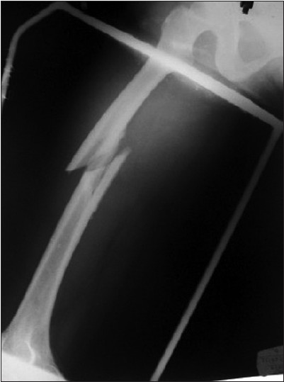 Figure 1: Preoperative radiograph of the patient showing a simple oblique fracture of femur