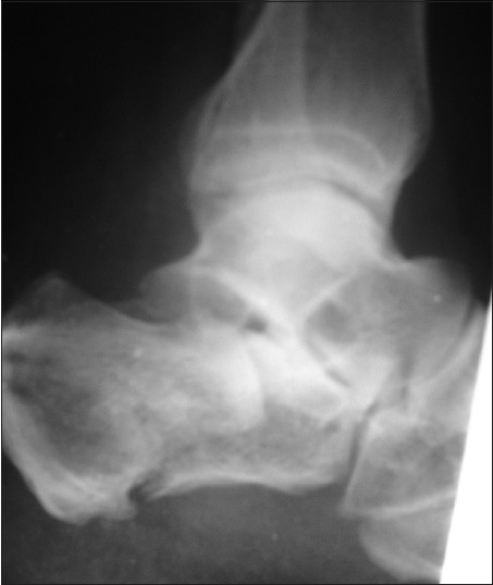 Figure 1: Pre-operative X-ray calcaneum lateral view showing tongue type fracture