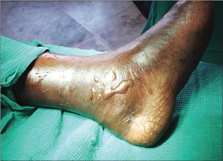 Figure 2: Pre-operative clinical picture of left foot showing blisters