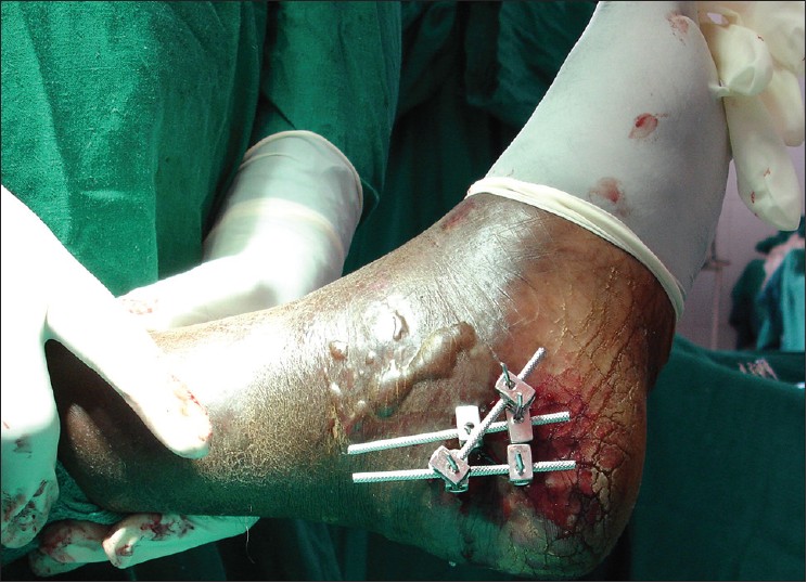 Figure 3: Clinical photograph after applying UMEX fixator