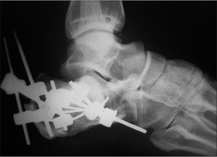 Figure 4: Post-operative X-ray left calcaneum lateral view showing fracture reduction