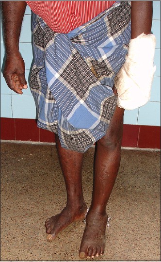 Figure 5: Clinical photograph showing full weight bearing walking two days following surgery