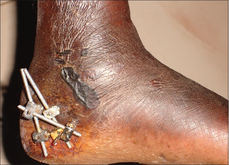 Figure 6: Two weeks follow up showing healed blisters