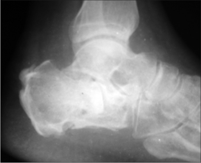 Figure 7: X-ray left calcaneum lateral view showing fracture union at 6 months follow up