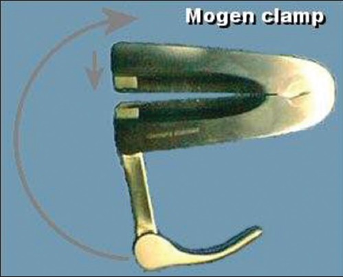Figure 1: Mogen clamp