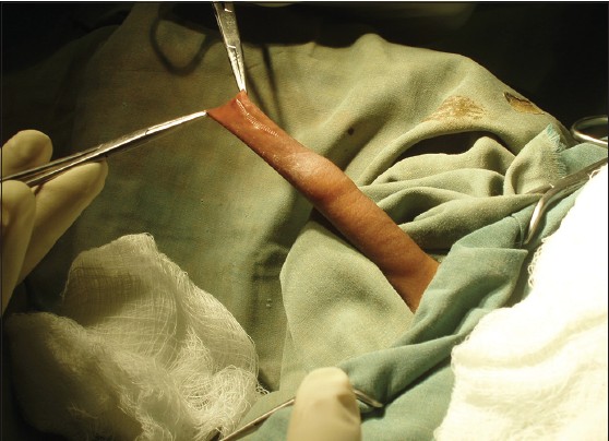Figure 12: Crushing the prepuce with artery clamp before incision