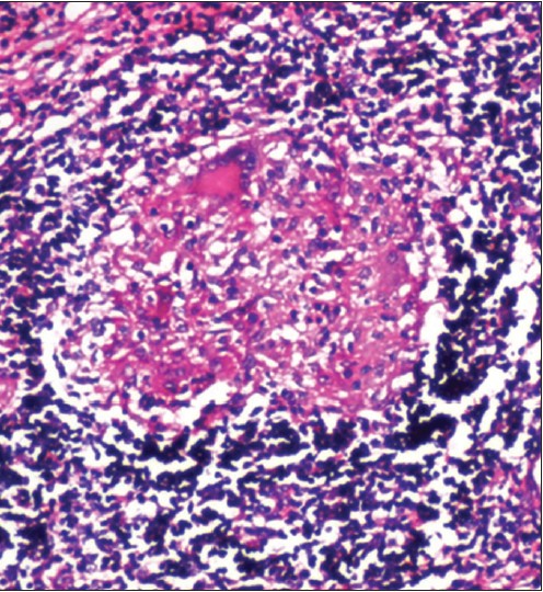 Figure 3: Histopathology showing epithelioid granuloma with langhans giant cells and neutrophilic infiltrate in the lumen of appendix (x10 magnification)