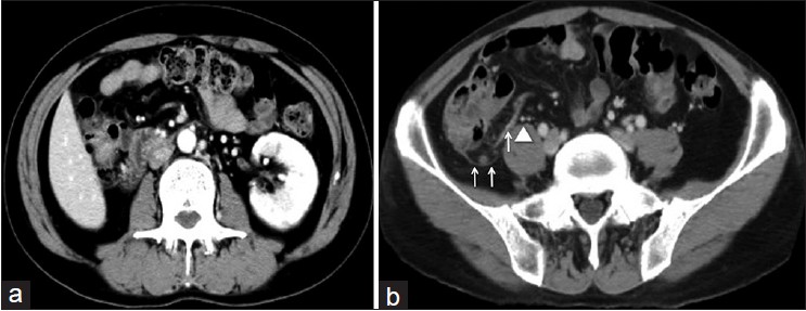 Figure 1: (a) Abdominal computed tomography showed that the right kidney was absent and the left kidney was hypertrophic and (b) the right testicular vessels (arrow head) were present behind the renal fascia (arrow)