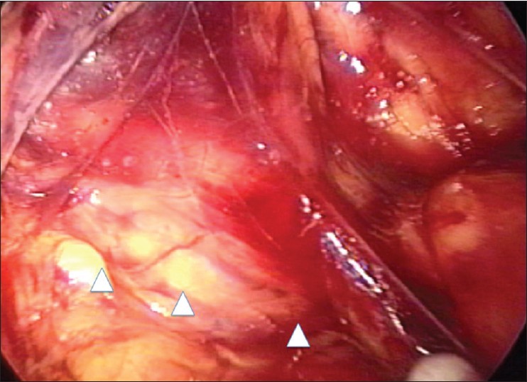 Figure 2: The right testicular vessels (arrow head) were preserved under the anterior renal fascia, but the right ureter was not identified