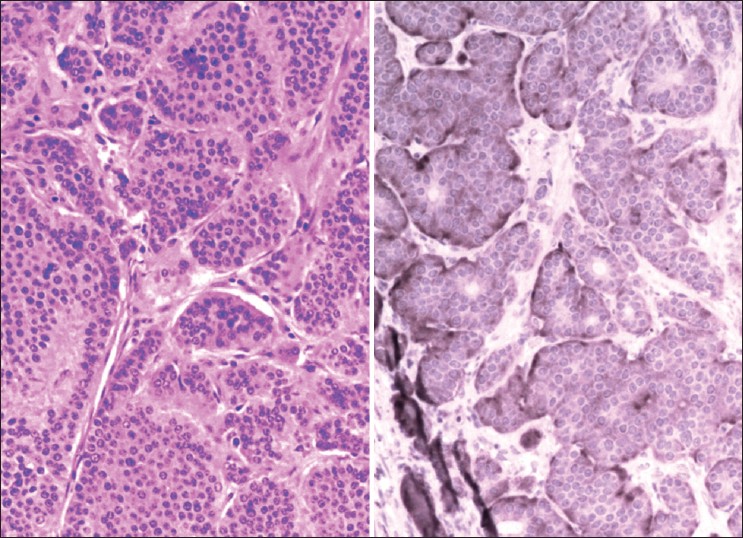 Figure 1: Histology‑carcinoid tumor