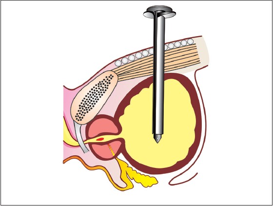 Figure 1: Entry of suprapubic cystostomy trocar in the bladder