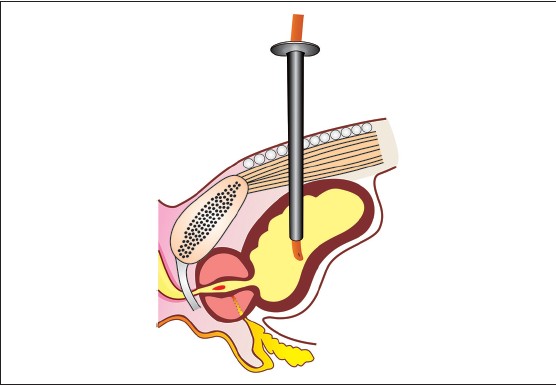 Figure 4: Keeping direction of slot toward umbilicus and slightly tilting cannula tip cephalad contribute safe placement of catheter into the lumen of bladder