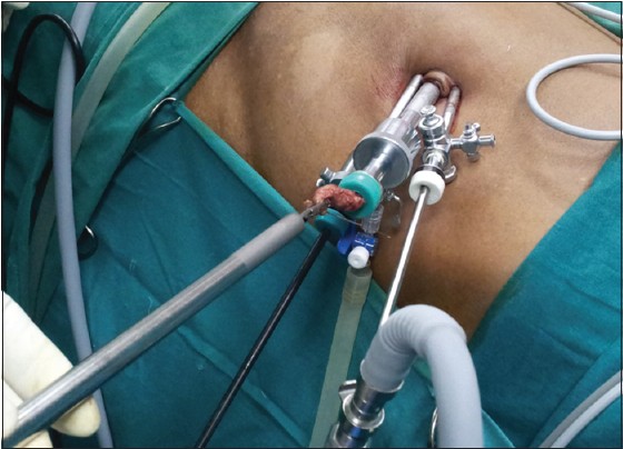 Figure 2: Port position.10 mm camera-port at 5 O'clock position and two 5 mm working ports at 7 and 12 O'clock. Appendix is being extracted through 10 mm port under laparoscopic vision from 5 mm trocar. Note
the position of light cable and port-valves