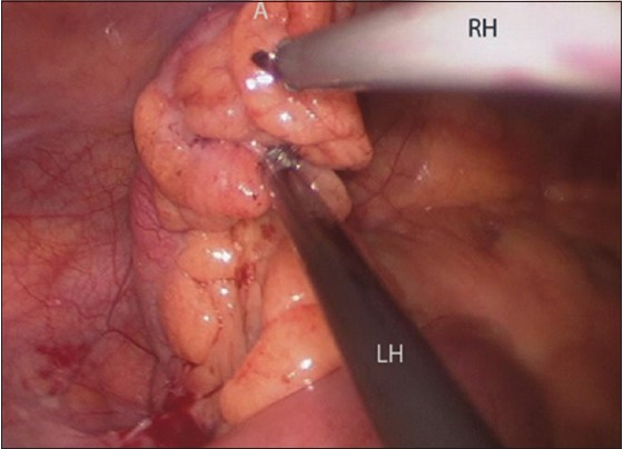 Figure 3: Trans-umbilical view of acutely inflamed and turgid appendix (A). Note the triangular ergonomics of right- and left- working instruments (RH and LH)