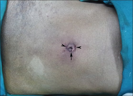 Figure 4: Post-operative umbilicus. Note near-invisible scars of 10 mm port (arrow) and 5 mm ports (arrow-heads)