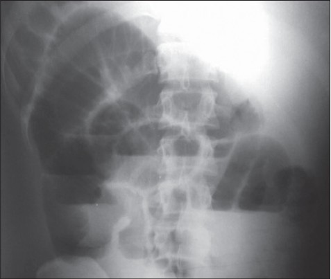 Figure 1: Plain X-ray showing small bowel obstruction