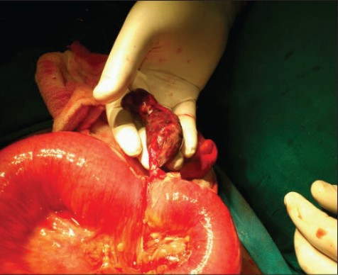 Figure 2: Gangrenous Meckelæs diverticulum causing obstruction of small bowel (after releasing the peritoneal band causing obstruction)