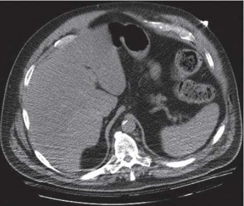 Figure 1: Computed tomography (CT) of abdomen during hospitalization for bilateral pneumonia is not showing any evidence of the chest wall hernia