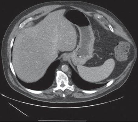 Figure 2: CT of abdomen 10 months after hospital discharge shows left side chest wall hernia through the torn intercostal muscles